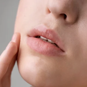 Upper Lip Laser Hair Removal