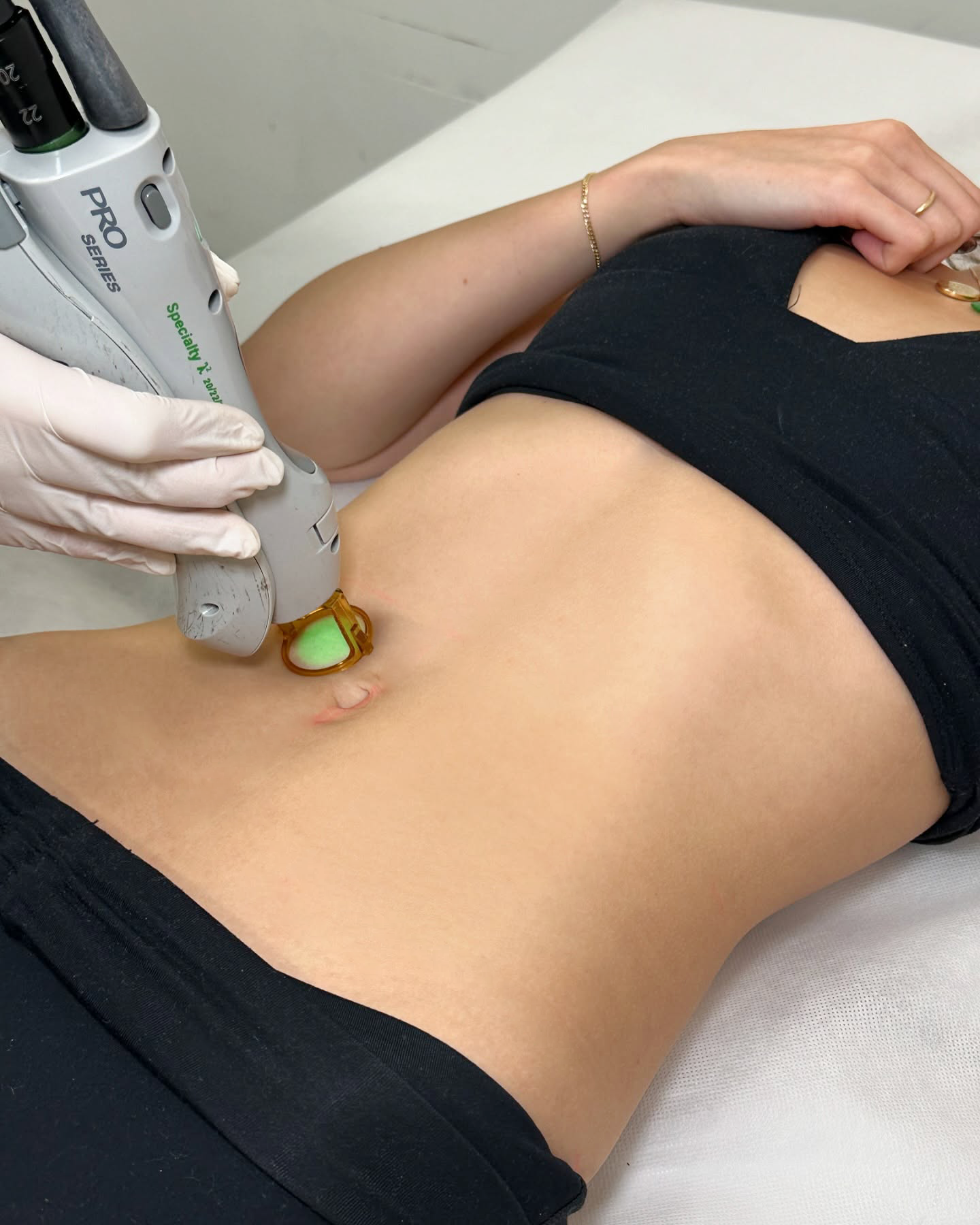 Stomach Laser Hair Removal
