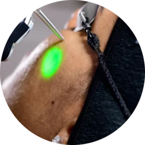 Cheeks Laser Hair Removal