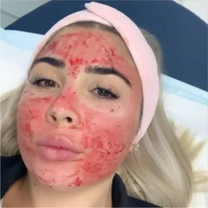 Vampire Facial Microneedling (PRP)