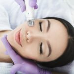 Potenza microneedling Pelham Parkway