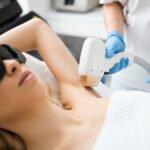 laser hair removal dark skin